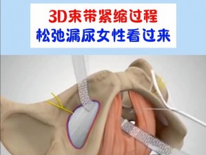 3d束带紧缩价钱 3D 束带紧缩手术价格是多少？